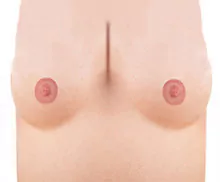 Bild mit einer Medical Pigmentierung Brust - Teilschattierung.