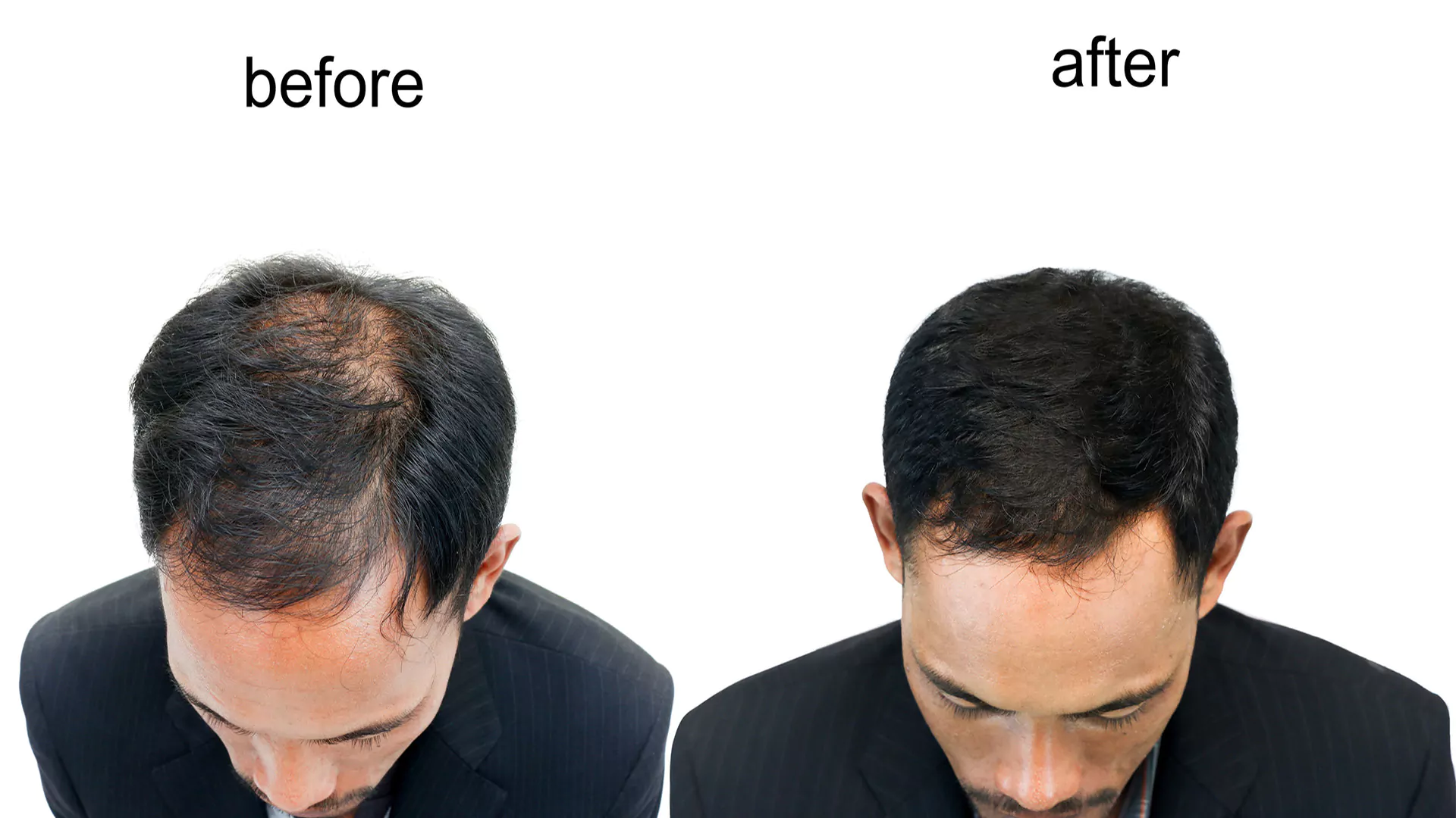 Bild mit einer Medical - Pigmentierung - Hairline Behandlung.