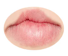 Bild mit einer Medical Lippen-Gaumen-Spalte Pigmentierung Behandlung.