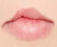 Bild mit einer Medical Pigmentierung - Lippen-Gaumen-Spalte Behandlung.