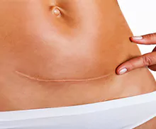 Bild mit einer Medical Pigmentierung - Kaiserschnitt - Narben Behandlung.